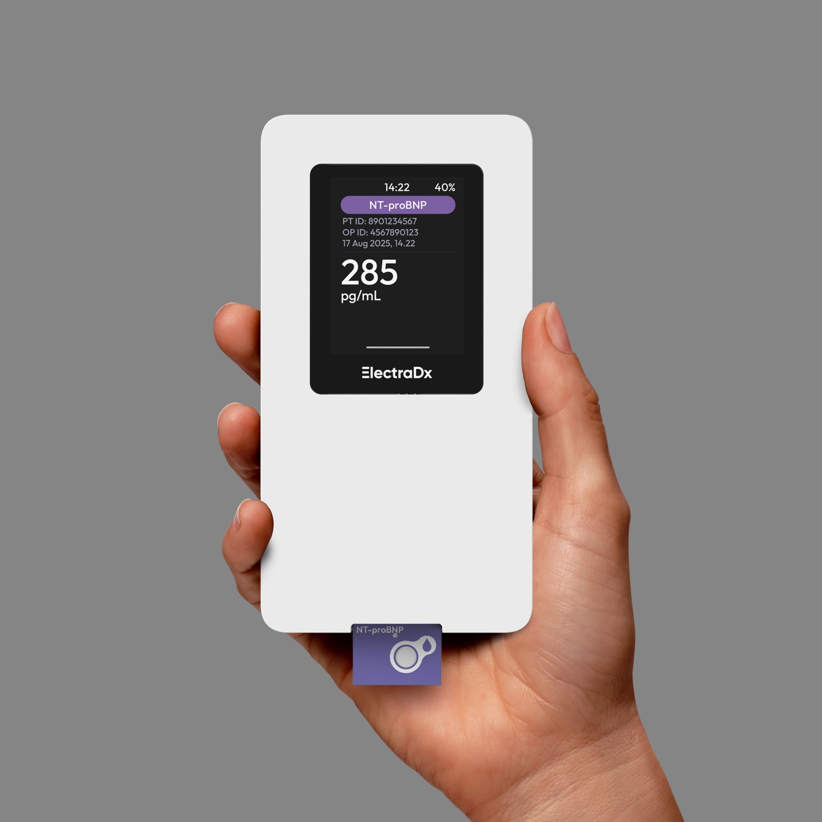 Hand holding the ElectraDx device displaying an NT-proBNP result